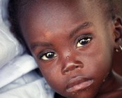 Ph. Luciano Nadalini | Bambina malnutrita nell'ospedale di Cacuaco | Angola, 1999 Ph. Luciano Nadalini | Bambina malnutrita nell'ospedale di Cacuaco | Angola, 1999